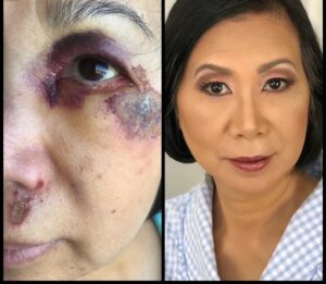professional makeup for scar coverage